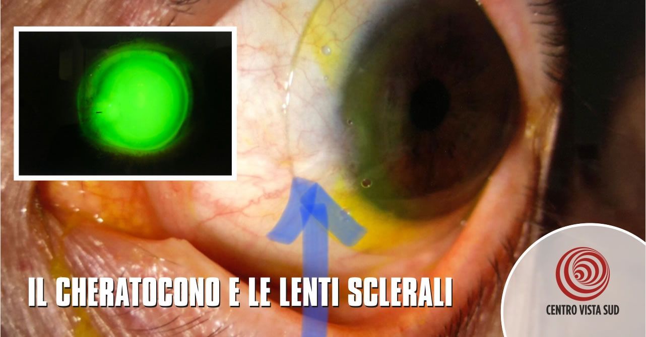 Il cheratocono e le lenti a contatto sclerali